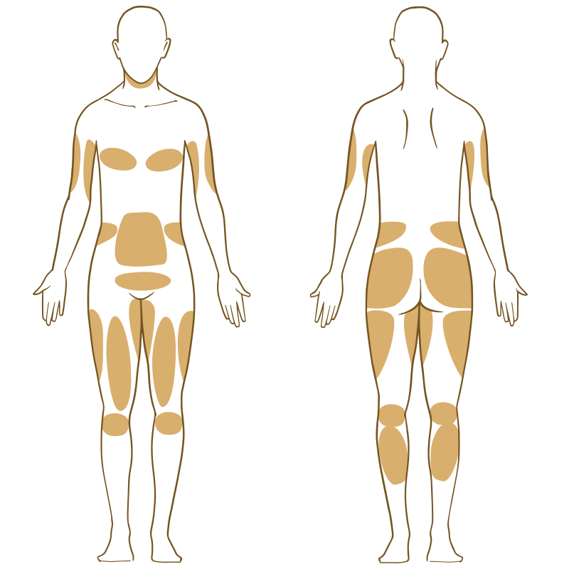 Liposuktion Körperzonen