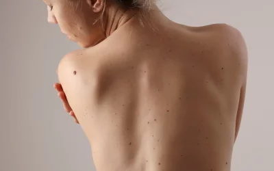 Erfahrungsbericht Hautkrebsvorsorge / Melanom / Muttermale